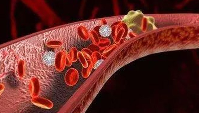 深靜脈血栓防治之流水不腐，戶樞不蠹