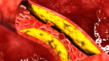 年度回眸、精彩擷萃丨2022年靜脈血栓防治領(lǐng)域十件大事