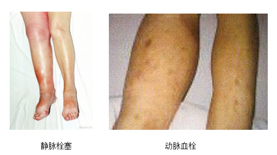 動(dòng)脈血栓和靜脈血栓有什么區(qū)別嗎？