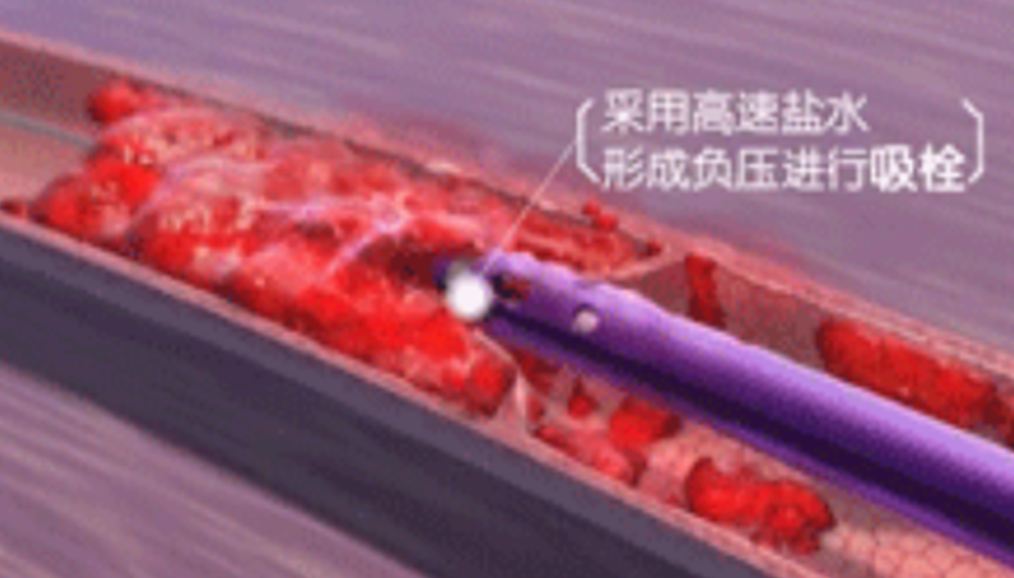 深靜脈血栓能致命，防治“大法”要了解！