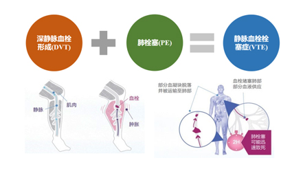 一例術后VTE致死引發(fā)的醫(yī)療糾紛