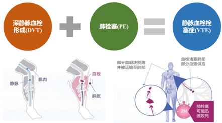 躺著也能防血栓？神經(jīng)肌肉電刺激來幫忙
