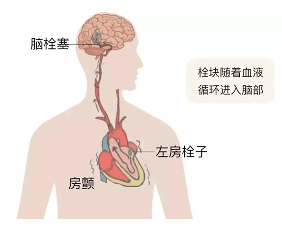 血栓是心梗、腦梗的元兇，很容易找上這些人