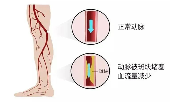 血栓是心梗、腦梗的元兇，很容易找上這些人