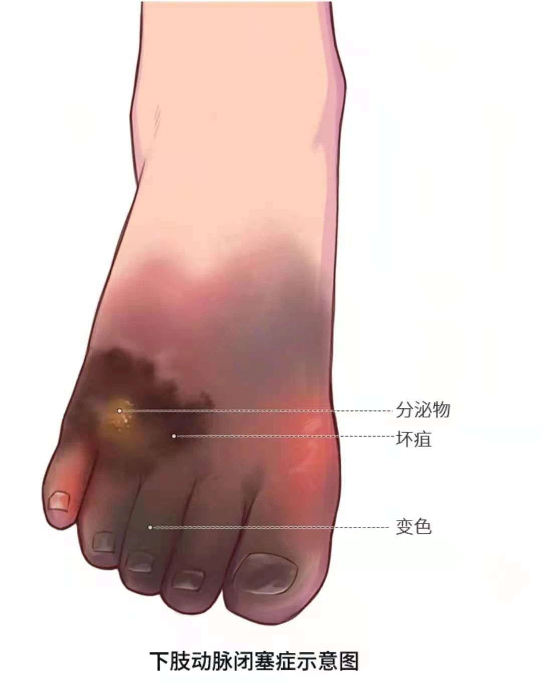 深靜脈血栓類似病癥的認(rèn)識(shí)與區(qū)分 深靜脈血栓類似病癥的認(rèn)識(shí)與區(qū)分