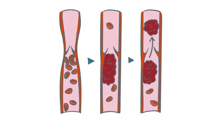 深靜脈血栓能致命，防治“大法”要了解！