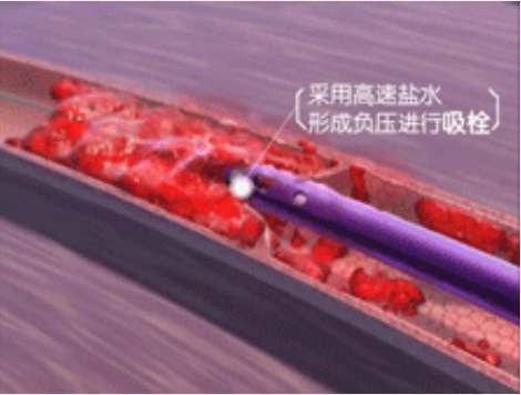 深靜脈血栓能致命，防治“大法”要了解！