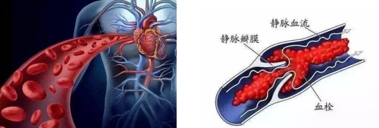 妊娠過程中的“潛伏殺手”——易栓癥 妊娠過程中的“潛伏殺手”——易栓癥